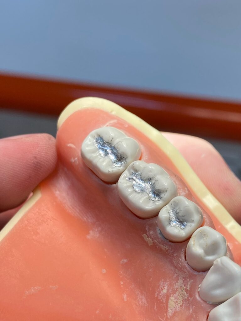 A dental amalgam filling in a tooth
