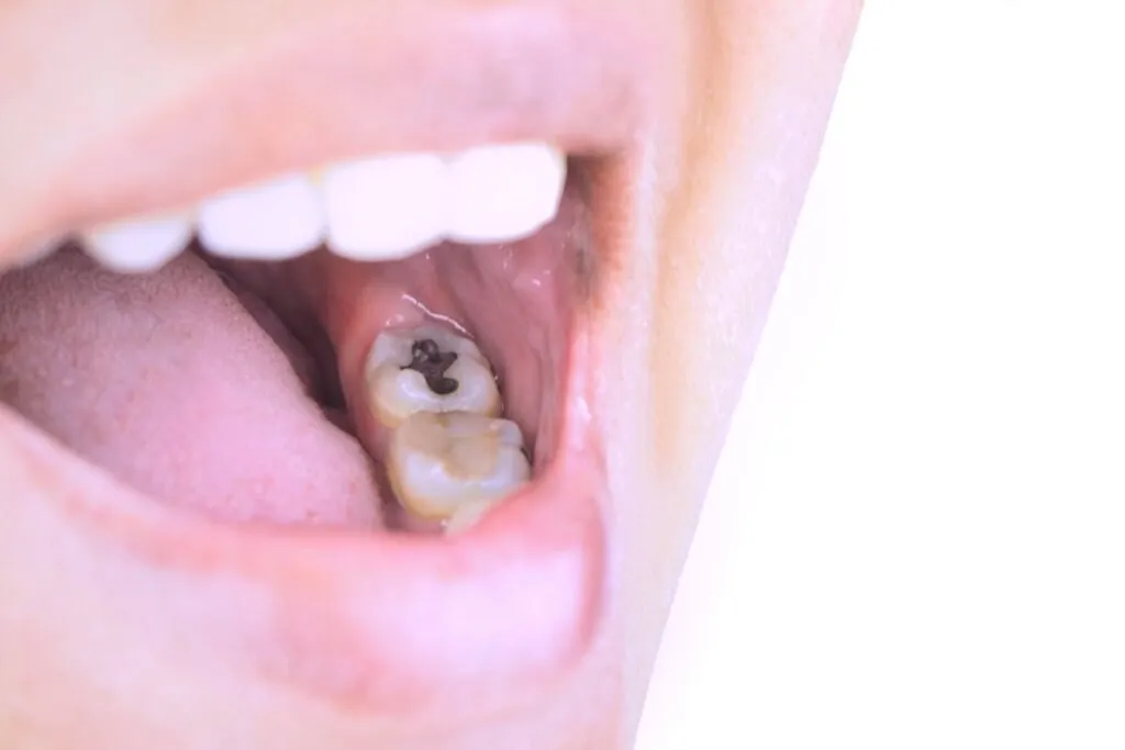 A molar with a visible cavity is highlighted.