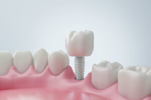 A 3D illustration of a dental implant in a human gum, surrounded by natural teeth