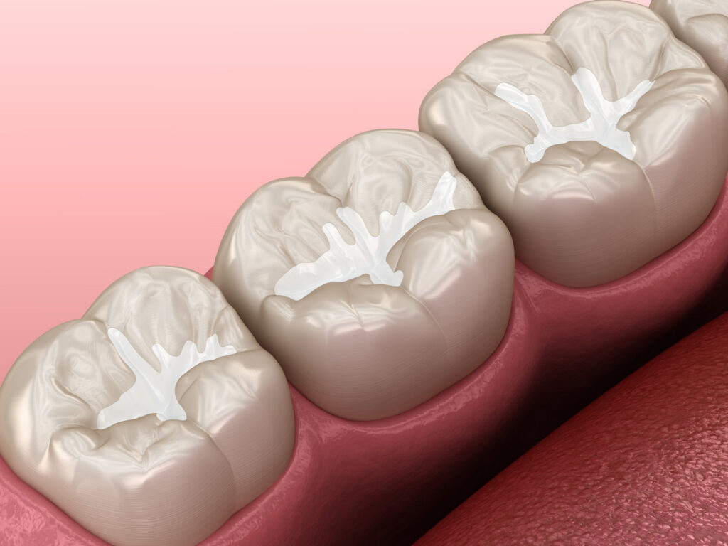 Molar Fissure dental fillings, Medically accurate 3D illustration of dental concept