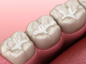 Molar Fissure dental fillings, Medically accurate 3D illustration of dental concept