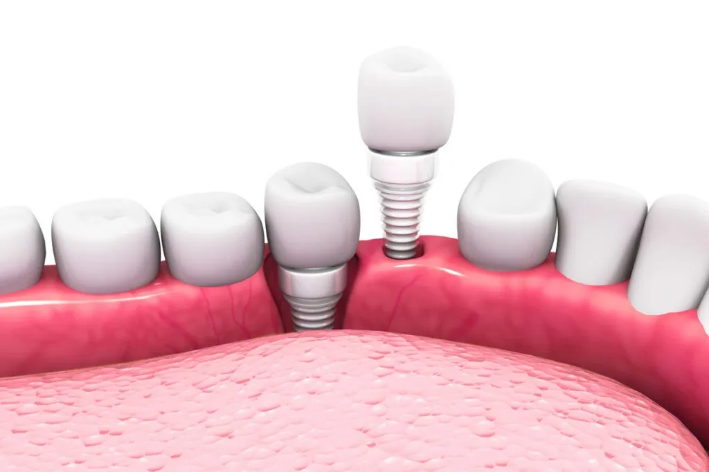 Dental implant structure.3d render