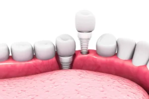 Dental implant structure.3d render