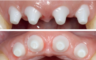 Before and after implant retained dentures at Club K Dental in Springfield MO